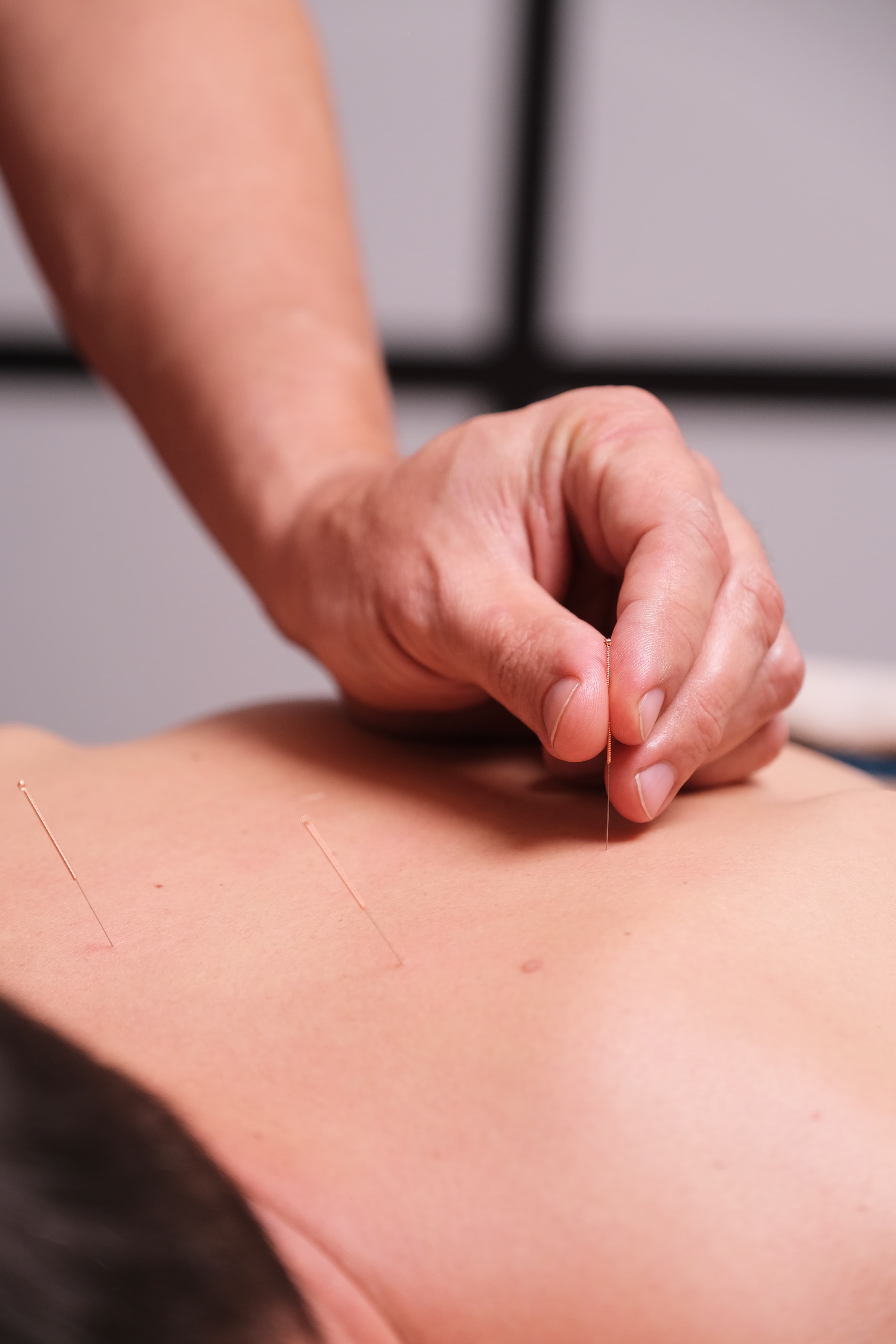 Acupuncture — 3