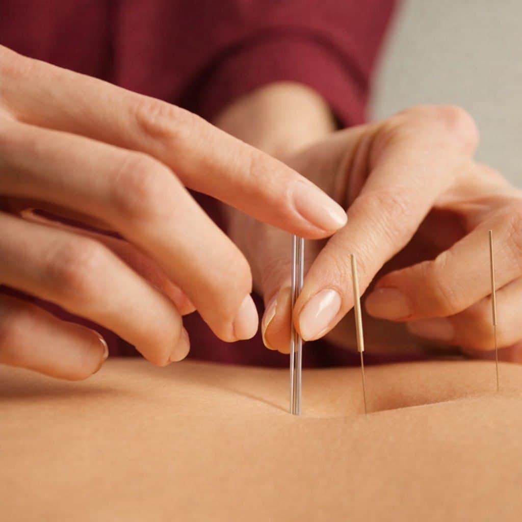 Acupuncture